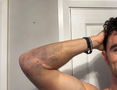 Glenn Irwin shows right arm bruising after Thruxton BSB high-side.