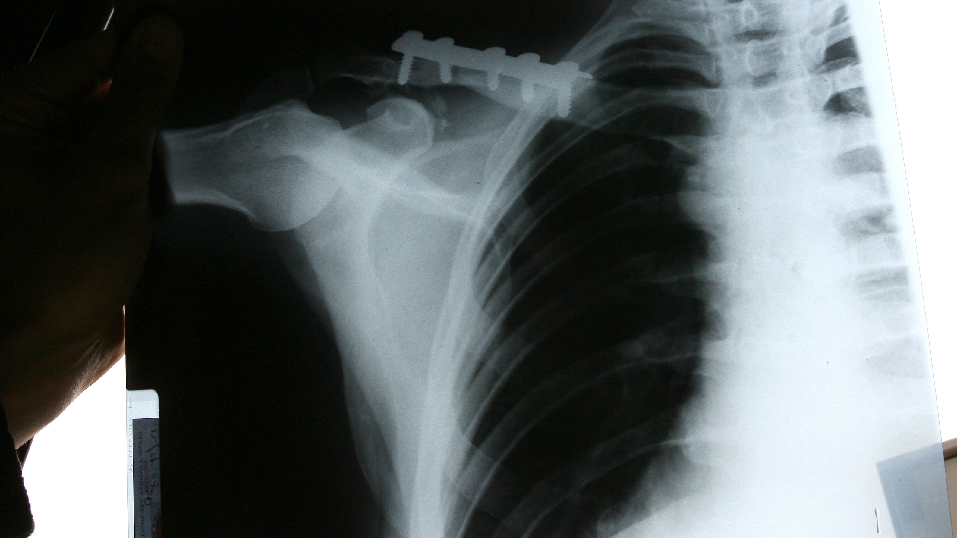 Curtain broken collar bone x-ray, Valencia WSS 2007